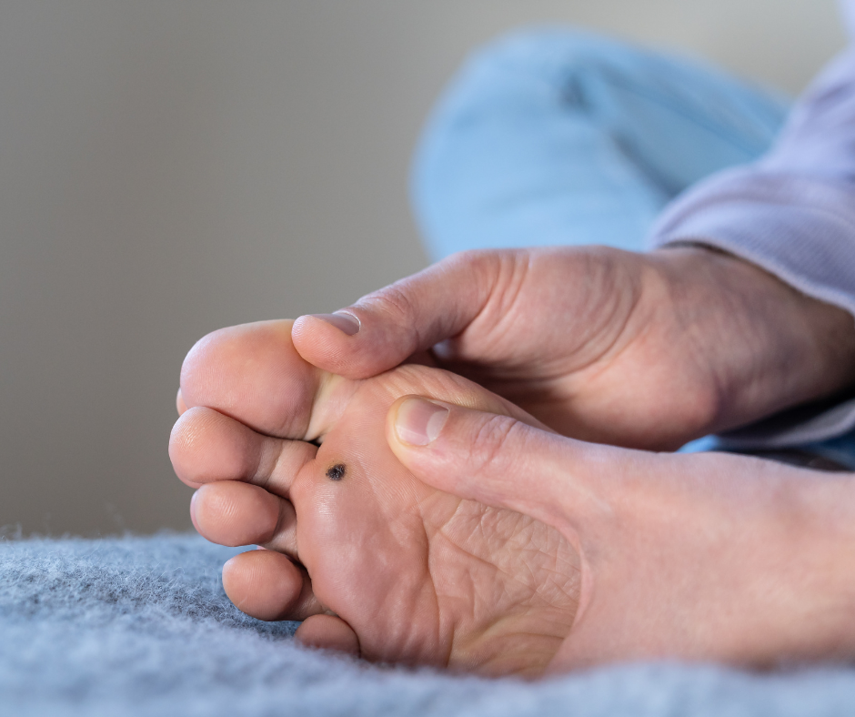 Why Your Plantar Wart Keeps Coming Back (and How Cleveland’s Newest Tech Fixes It for Good)